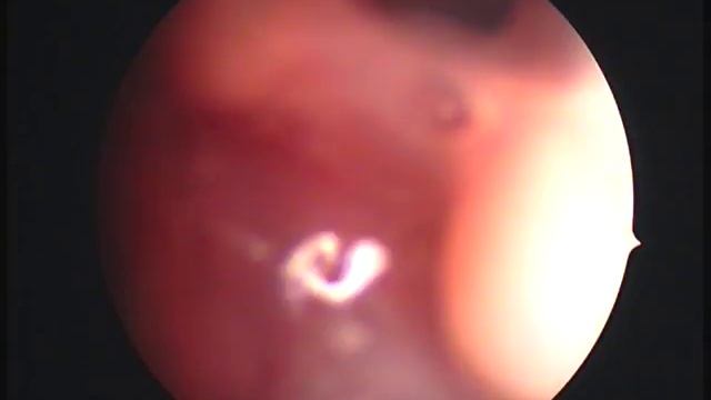 Stenosis of larynx(стеноз гортани у йорка) смотреть онлайн