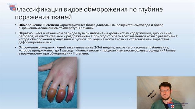 Обморожение смотреть онлайн