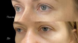 Нижняя блефаропластика | Трансконъюнктивальная пластика век