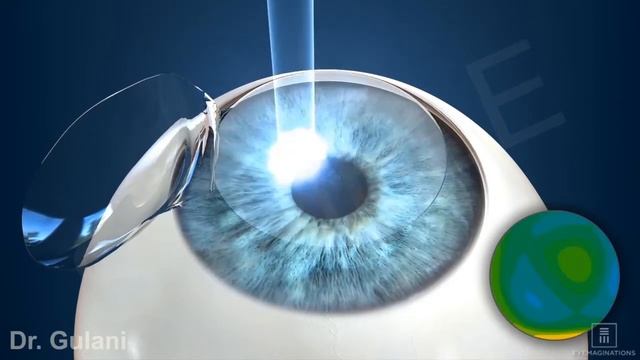 Topography Guided Lasik смотреть онлайн