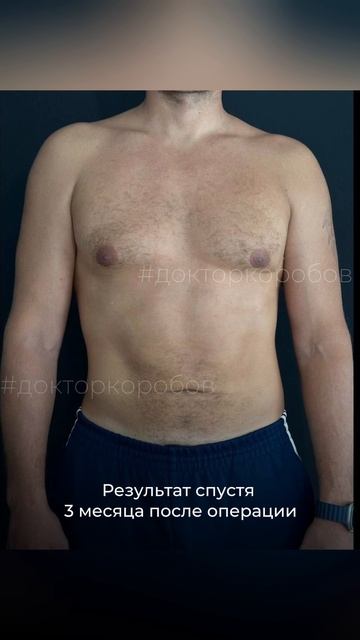 МУЖСКАЯ ПЛАСТИКА | Результаты спустя 3 месяца смотреть онлайн