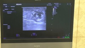 Введение раствора анестетика вокруг вены с проведённым в ней световодом.