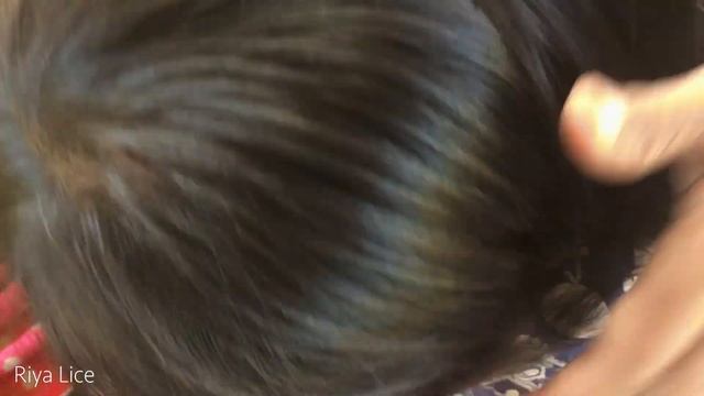 Picking out all hundred lice from head - Removing a lot of big lice смотреть онлайн