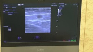 Пункция вены и проведение световода в просвете вены до сафено-поплитеального соустья