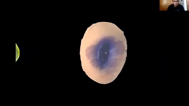 Conferencia: Transplante de células estromales mesenquimales para la regeneración de la pulpa denta смотреть онлайн