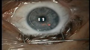 ФРК -  Лазерная коррекция зрения