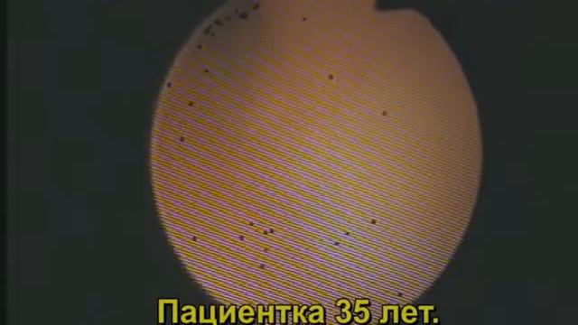 Офисная гибкая гистероскопия. Преимущества метода. смотреть онлайн