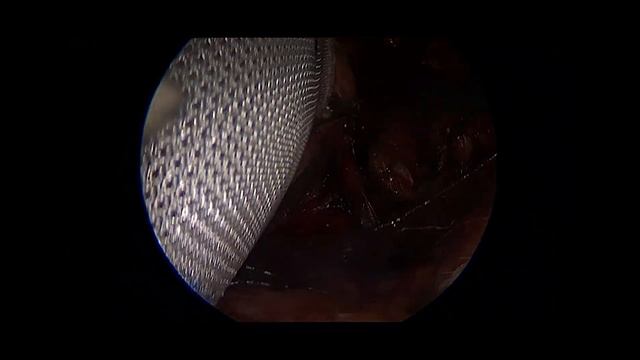 Лечение паховой грыжи смотреть онлайн