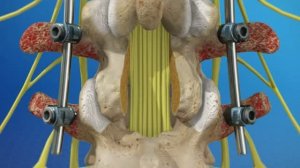 Фиксация поясничного отдела позвоночника