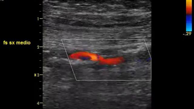 SUPERFICIAL FEMORAL ARTERY STENOSIS смотреть онлайн