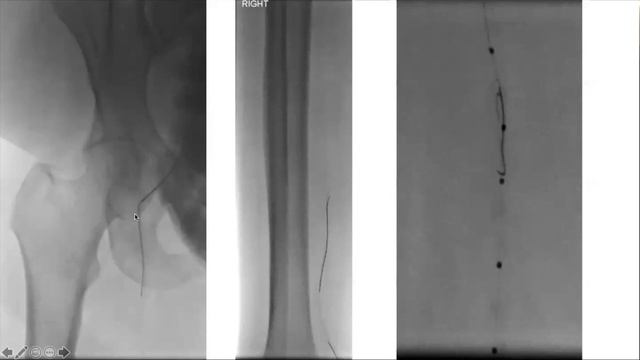 SFA CTO Antegrade and Retrograde Access for Crossing & Treatment смотреть онлайн