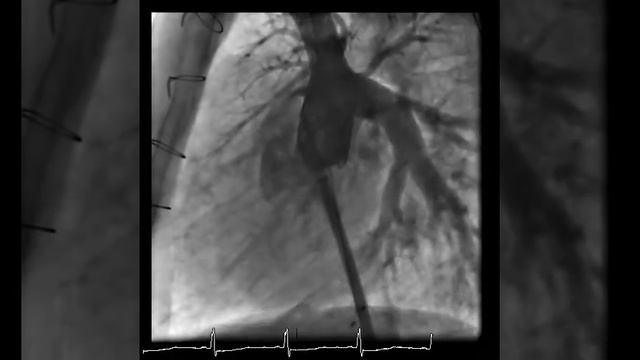 Vol.5 Issue 1 Video 1: Transcatheter Revision of Fontan Circulati... смотреть онлайн