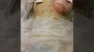 Липофилинг груди