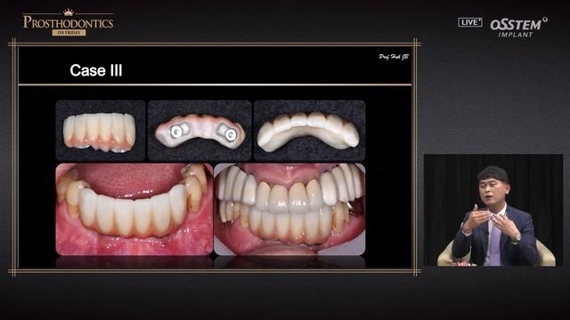 [PROSTHODONTICS] How to Solve Challenging Cases Using Implant Bar Attachment смотреть онлайн