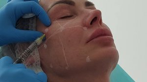 Техника болюсного введения биоревитализанта JALUPRO SUPER HYDRO