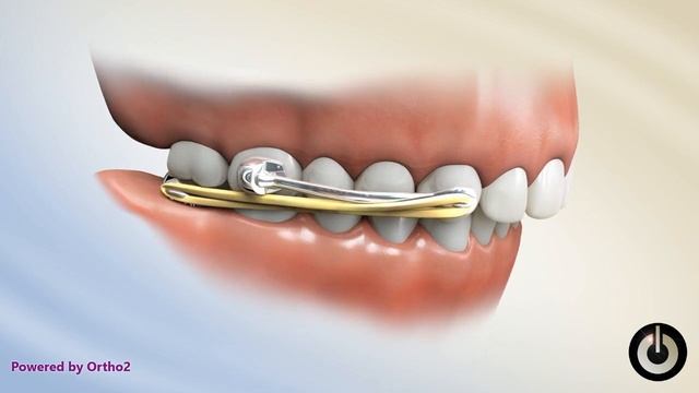 Carriere Class II Motion with Lower Lingual Arch смотреть онлайн