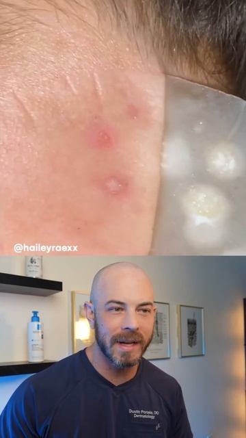 Derm reacts to satisfying hydrocolloid patch removal! #hydrocolloidpatch смотреть онлайн