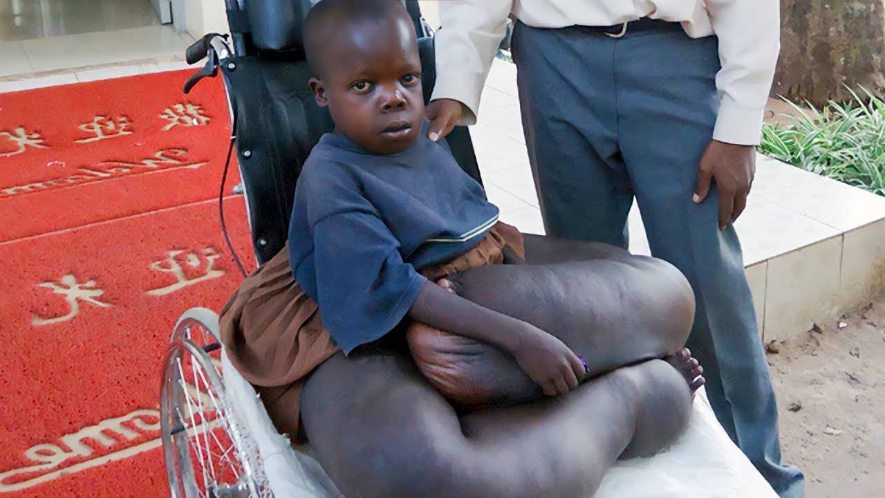 Врачи не могли поверить своим глазам, увидев этого мальчика-слона смотреть онлайн