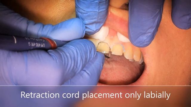 Anterior ceramic crowns - preparation, impression and temporization смотреть онлайн