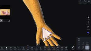 Контрактура Дюпюитрена