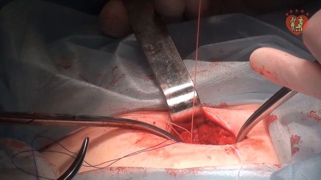 Операция. Грыжа пупочного кольца