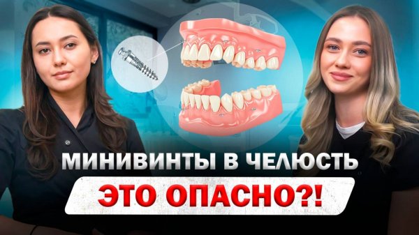 Минивинты в ортодонтии — это опасно? ВСЕ о минивинтах