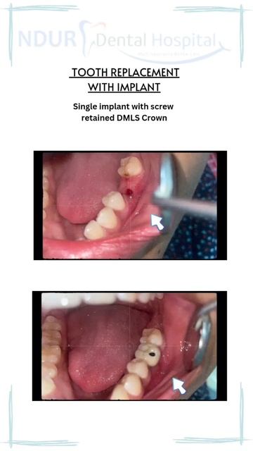 single implant with screw retained DMLS crown @ indur dental hospital nizamabad смотреть онлайн