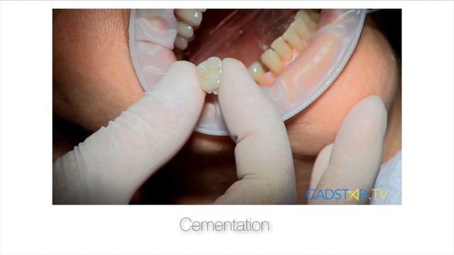Cementing e.max Live in the CEREC Clinical Theater with Dr. Klim смотреть онлайн