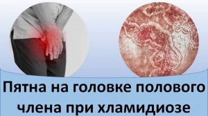 Пятна на головке полового члена при хламидиозе