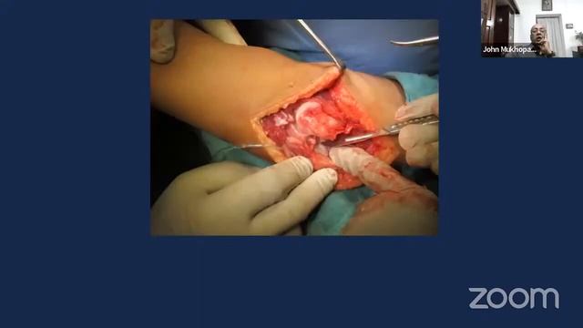 Oref India: Interesting Cases – Approach and Management Late Presenting Pediatric Elbow Fracture смотреть онлайн