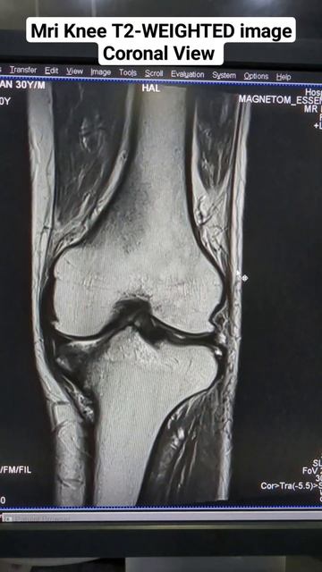 MRI Knee T2 Coronal Sequence View | MRI knee Anatomy & Pathology beginner radiology | t2_cor смотреть онлайн