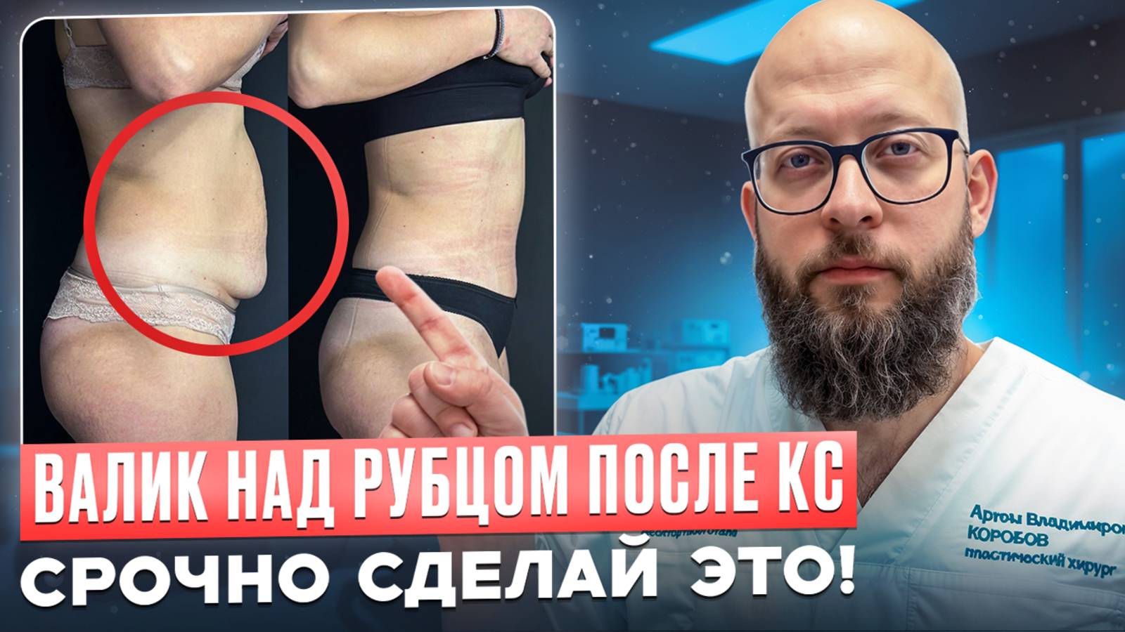 Как избавиться от валика над рубцом от кесарево смотреть онлайн