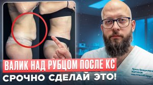 Как избавиться от валика над рубцом от кесарево