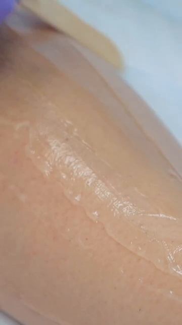 Лазерная эпиляция в Epil Story #лазернаяэпиляция #депиляция #электроэпиляция #косметология смотреть онлайн