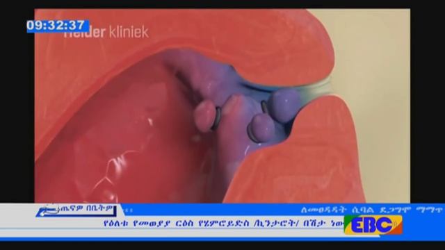 #EBC ጤናዎ በቤትዎ - የኪንታሮች ጤና ችግር ዙሪያ ከባለሙያ ጋር የተደረገ የቀጥታ ውይይት ተከታተሉ ተቀረበ ውይይት смотреть онлайн