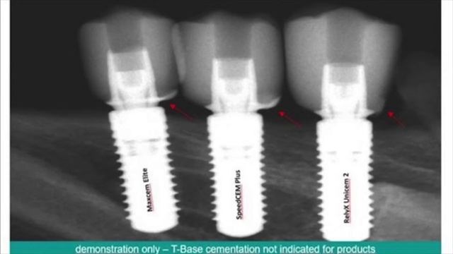 CEREC Restorations with SpeedCEM Plus смотреть онлайн