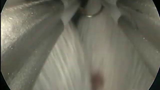 Bipolar resection endometrial polyp - Биполарна ресекција на полип смотреть онлайн