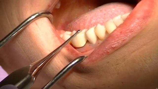 WAMKey Crown Removal - Bridge Removal - WAM key Crown Remover by Filay Dent смотреть онлайн