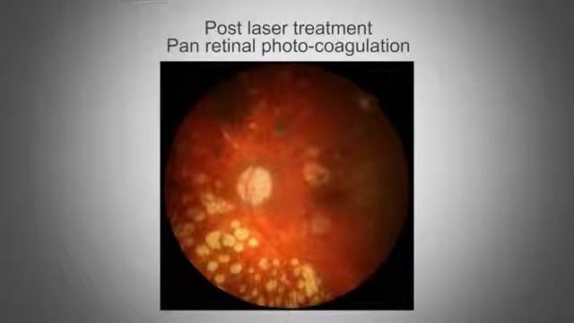 3D Canon Обучение 8 Лечение Настройка цифровых фильтров и ПО для автофлуоресценции глазного дна смотреть онлайн