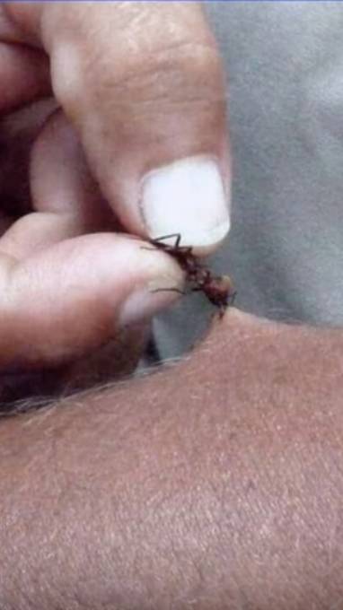 В Африке муравьев используют для заживления ран смотреть онлайн