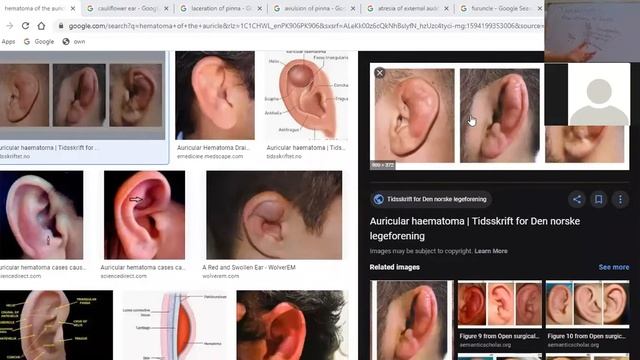 Disease of External Ear I Congenital and Traumatic Diseases of Pinna смотреть онлайн