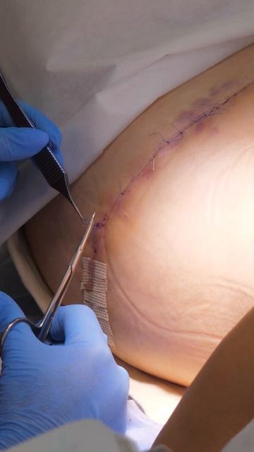 Абдоминопластика. Алла. Наложение склеек #shorts смотреть онлайн