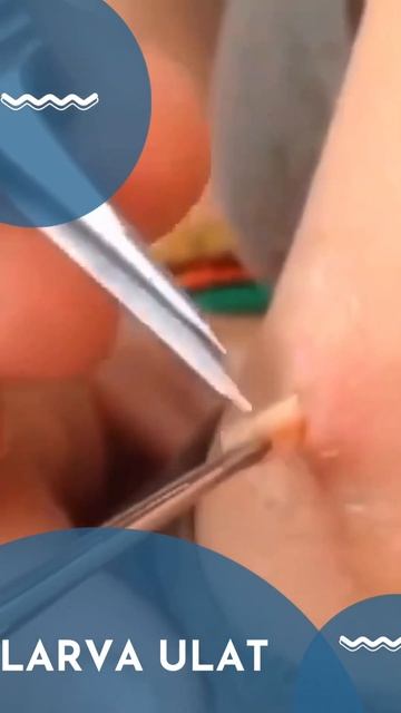Larva Ulat masuk ketubuh Manusia #kejadiantakterduga #kejadianterkini #menjinakkan смотреть онлайн