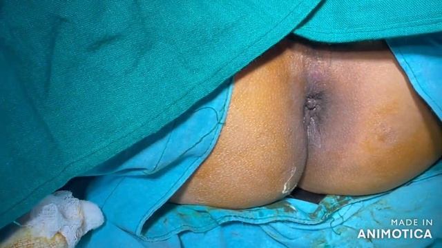 perineal block for Heamorrhoid/ fissure in ano surgery смотреть онлайн