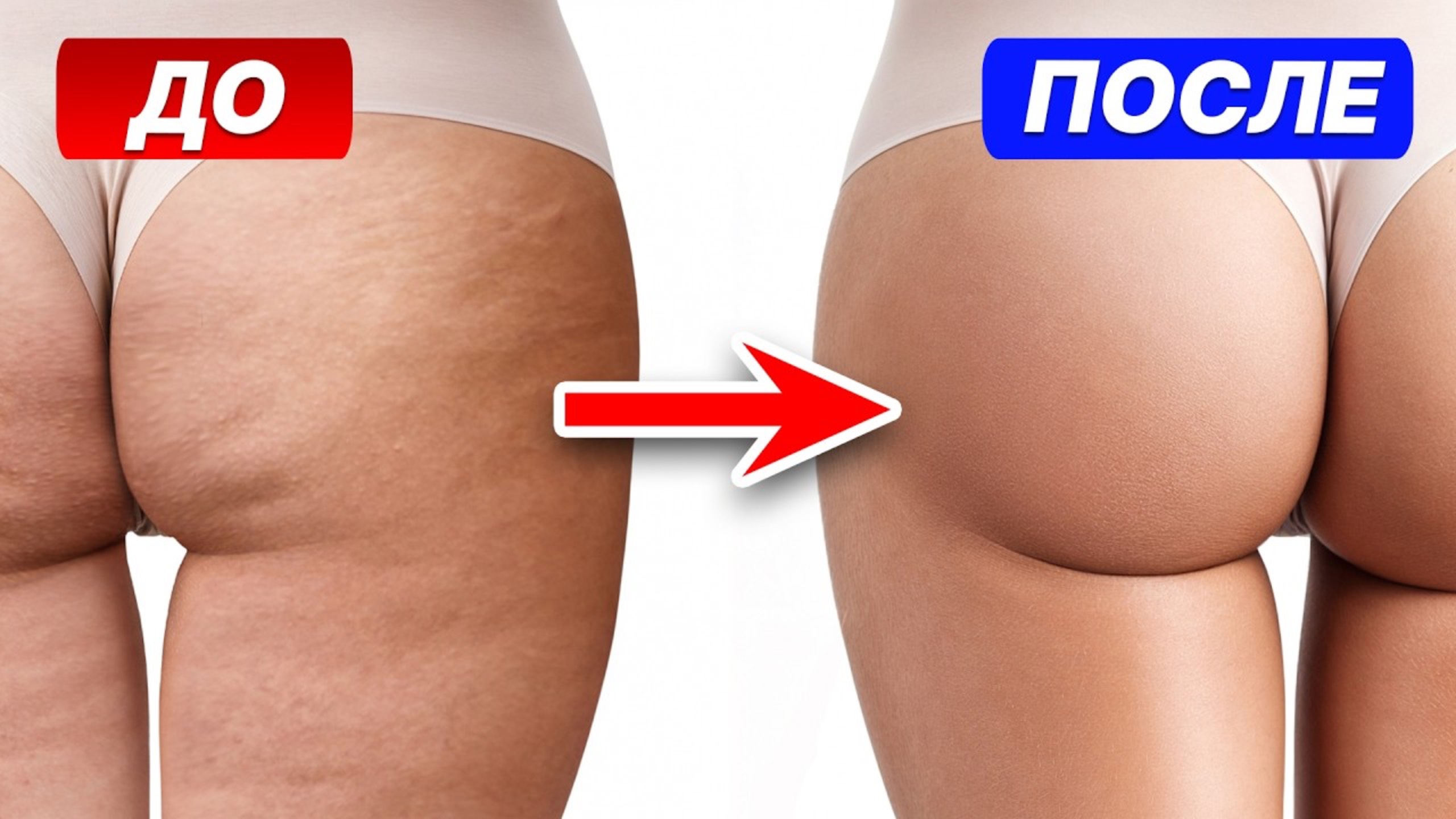 ЛУЧШИЙ способ избавиться от целлюлита РАЗ и НАВСЕГДА! / Как убрать целлюлит БЕЗ ОПЕРАЦИЙ?