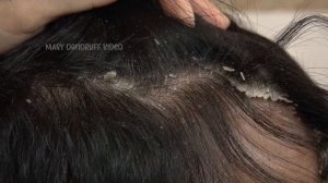 BIG Dandruff Flakes Scratching On My Brother's Head #772