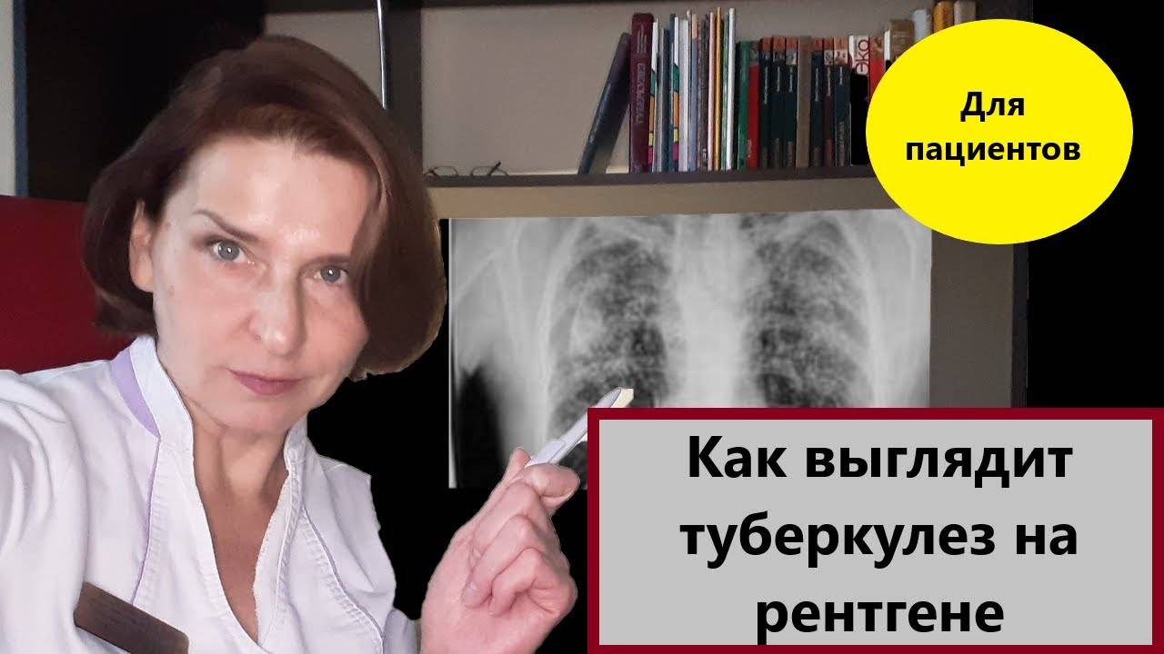 Рентген туберкулеза смотреть онлайн