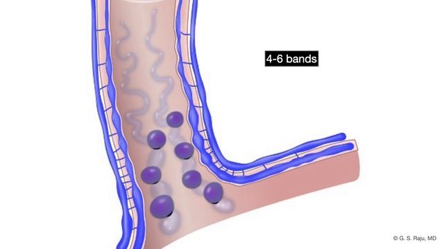 Liver Cirrhosis Portal HTN 3c Esophageal Variceal Bleeding Endoscopic Rx смотреть онлайн