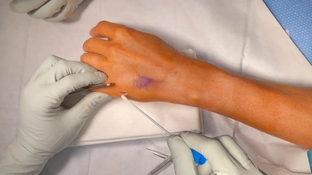 Foreign Body Removal Left Hand; Hogfish Spine Removal (Foreign Object Excision) смотреть онлайн