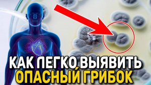 ОПАСНЫЙ ГРИБОК и КАК ЛЕГКО ВЫЯВИТЬ ГРИБЫ в организме - КАК ИЗБАВИТЬСЯ - КАК ЛЕЧИТЬ